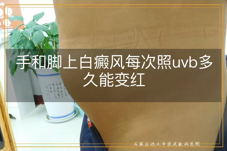 手和脚上白癜风每次照uvb多久能变红