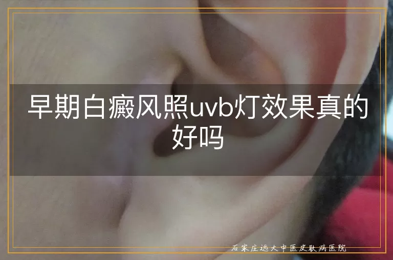 早期白癜风照uvb灯效果真的好吗