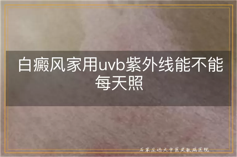 白癜风家用uvb紫外线能不能每天照