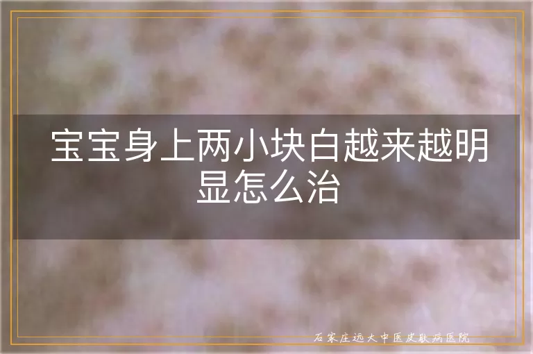 宝宝身上两小块白越来越明显怎么治
