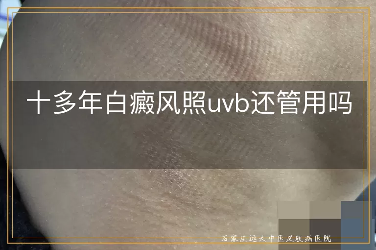 十多年白癜风照uvb还管用吗