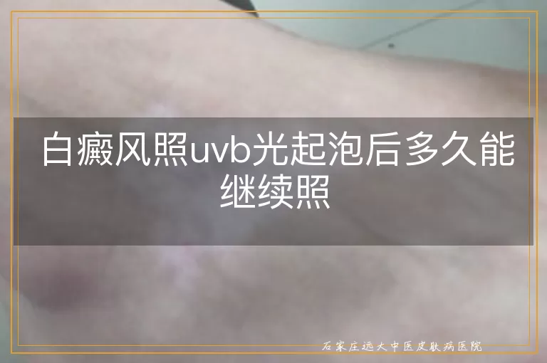 白癜风照uvb光起泡后多久能继续照
