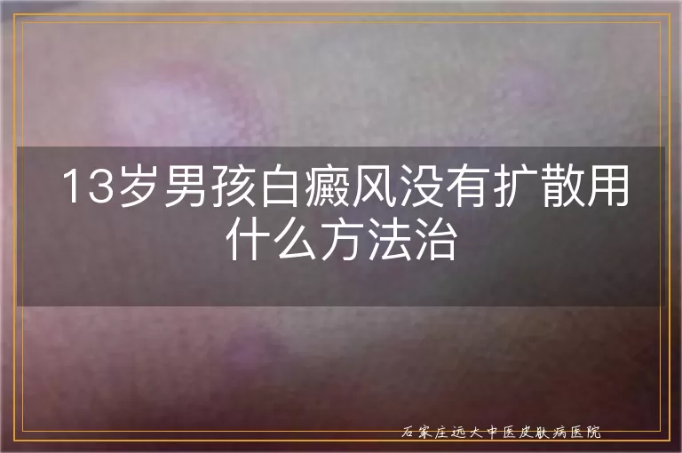 13岁男孩白癜风没有扩散用什么方法治
