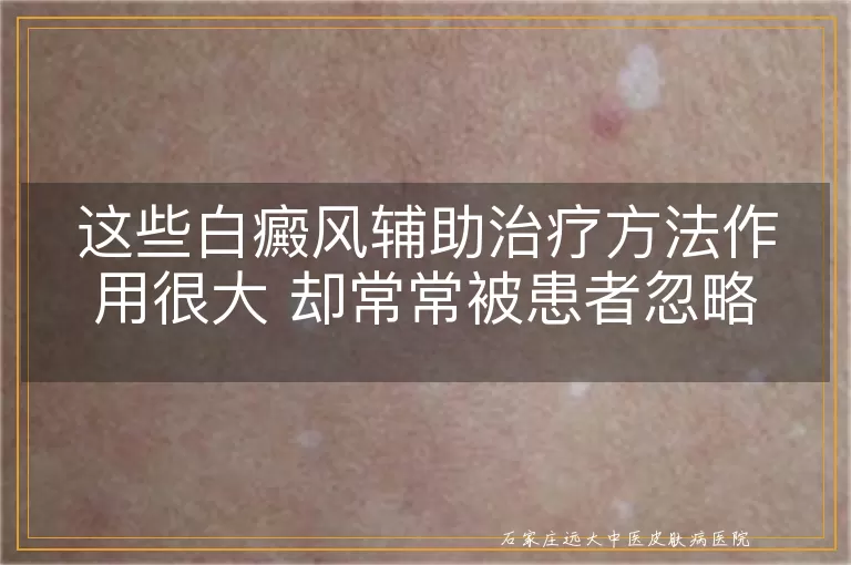 这些白癜风辅助治疗方法作用很大 却常常被患者忽略
