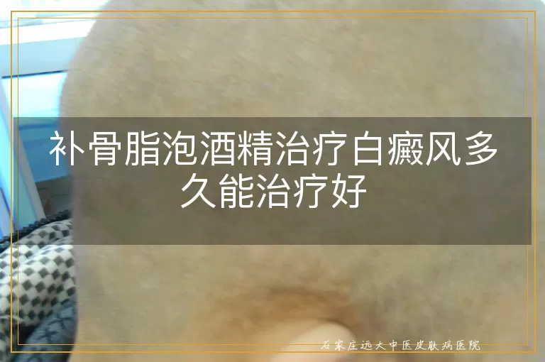 补骨脂泡酒精治疗白癜风多久能治疗好