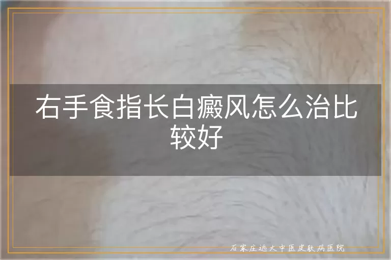 右手食指长白癜风怎么治比较好