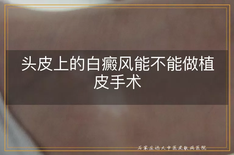 头皮上的白癜风能不能做植皮手术