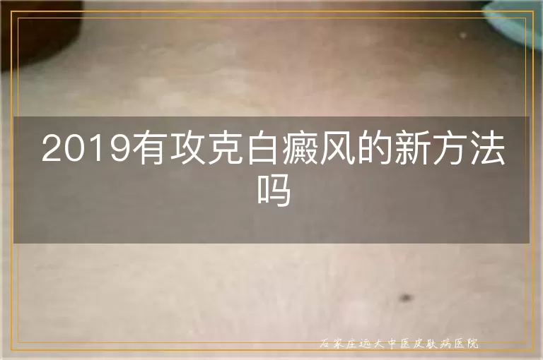 2019有攻克白癜风的新方法吗