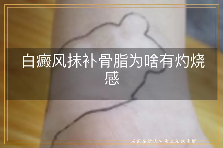 白癜风抹补骨脂为啥有灼烧感