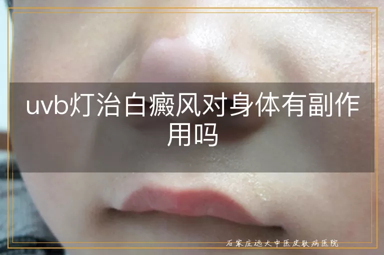 uvb灯治白癜风对身体有副作用吗