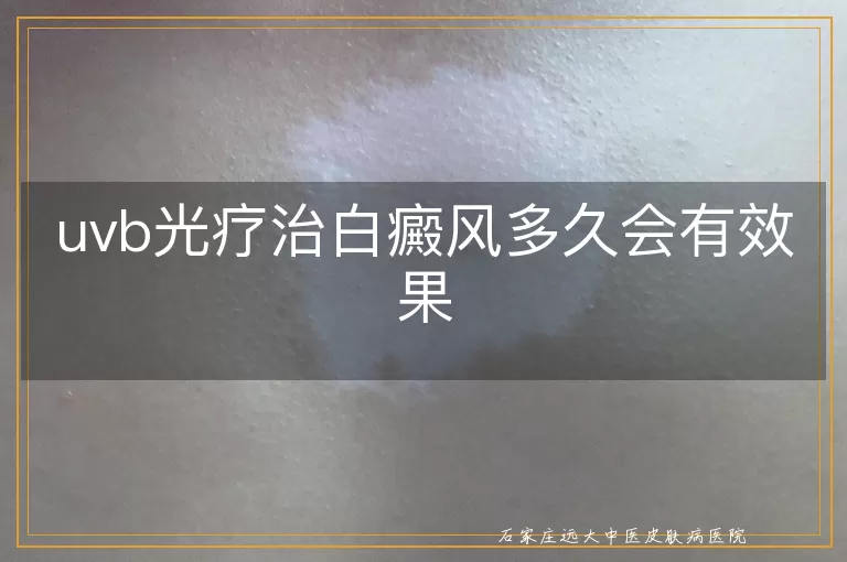 uvb光疗治白癜风多久会有效果