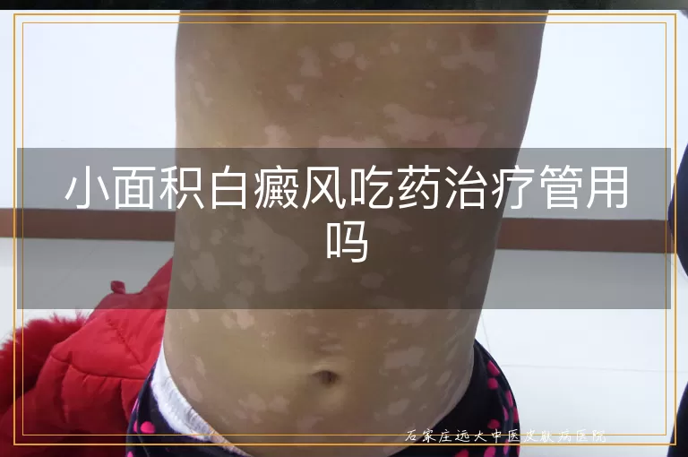 小面积白癜风吃药治疗管用吗