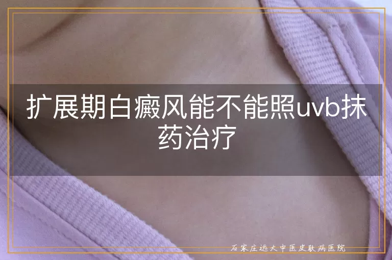 扩展期白癜风能不能照uvb抹药治疗