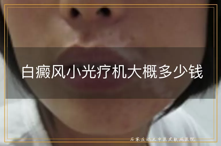 白癜风小光疗机大概多少钱