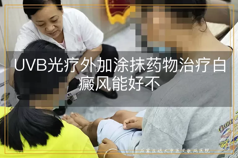 UVB光疗外加涂抹药物治疗白癜风能好不