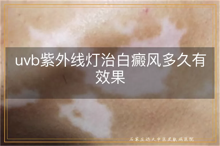 uvb紫外线灯治白癜风多久有效果