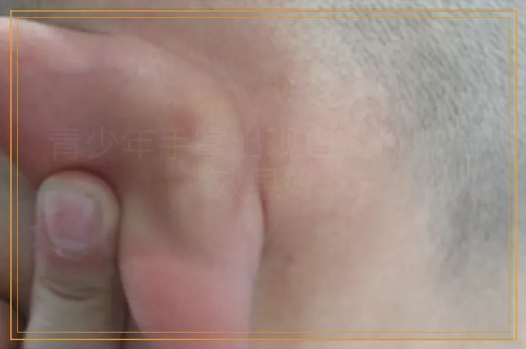 青少年手掌出现白癜风咋治效果好