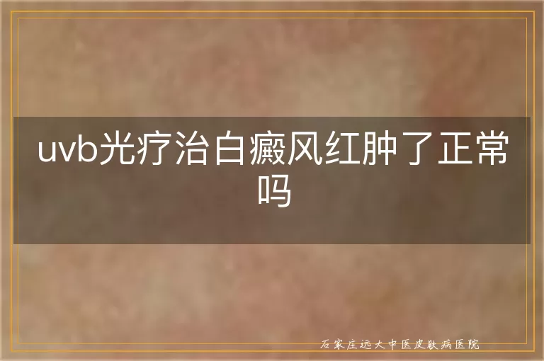 uvb光疗治白癜风红肿了正常吗