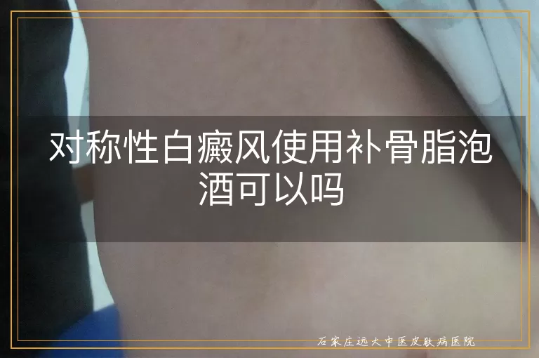 对称性白癜风使用补骨脂泡酒可以吗