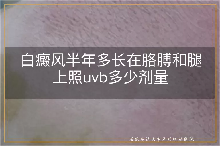 白癜风半年多长在胳膊和腿上照uvb多少剂量