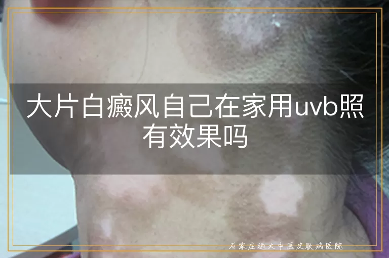 大片白癜风自己在家用uvb照有效果吗