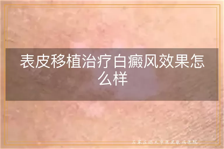 表皮移植治疗白癜风效果怎么样