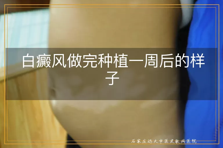 白癜风做完种植一周后的样子