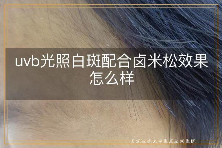 uvb光照白斑配合卤米松效果怎么样