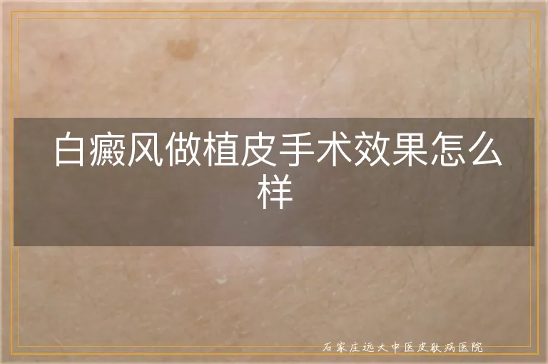 白癜风做植皮手术效果怎么样