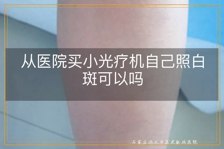从医院买小光疗机自己照白斑可以吗