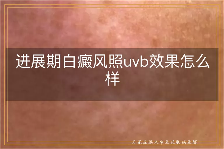 进展期白癜风照uvb效果怎么样