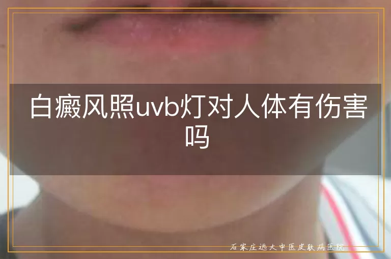 白癜风照uvb灯对人体有伤害吗
