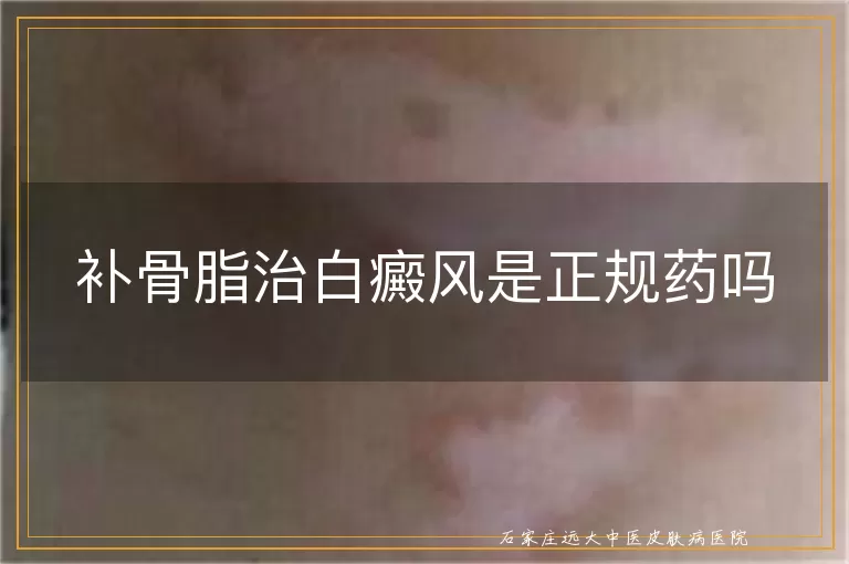 补骨脂治白癜风是正规药吗