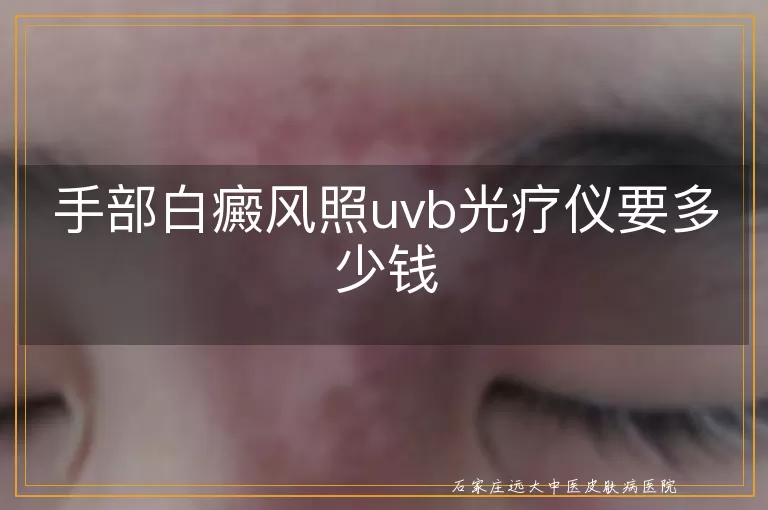 手部白癜风照uvb光疗仪要多少钱
