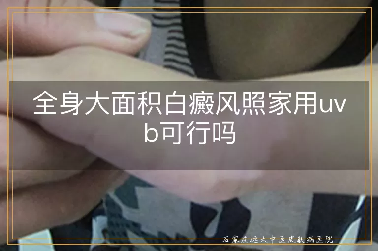 全身大面积白癜风照家用uvb可行吗