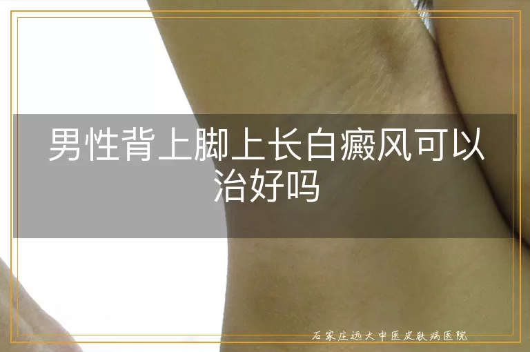 男性背上脚上长白癜风可以治好吗