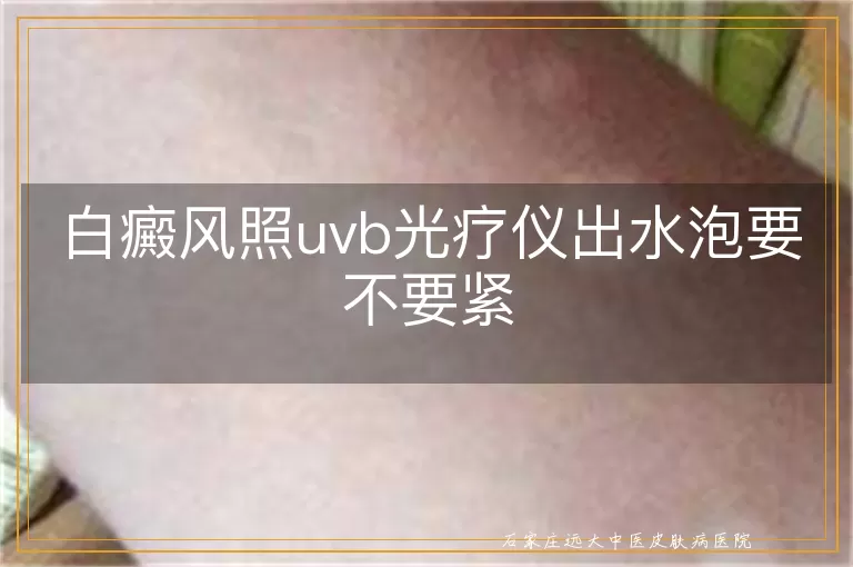 白癜风照uvb光疗仪出水泡要不要紧