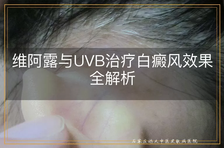 维阿露与UVB治疗白癜风效果全解析
