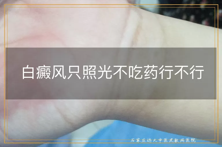 白癜风只照光不吃药行不行