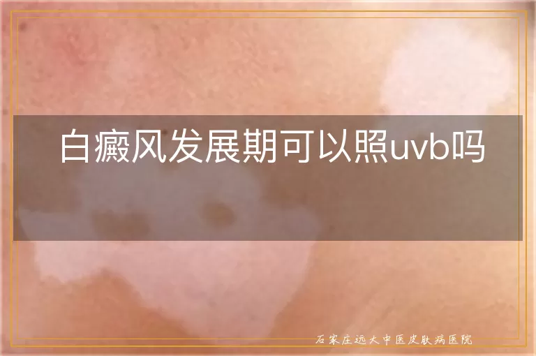 白癜风发展期可以照uvb吗