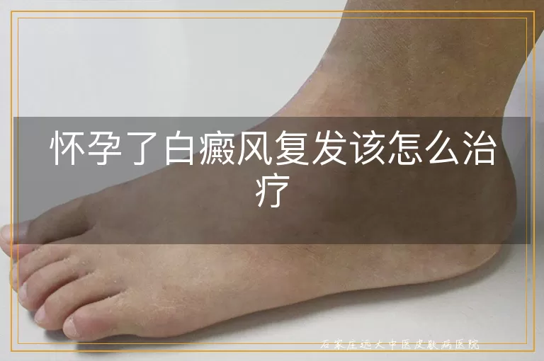 怀孕了白癜风复发该怎么治疗