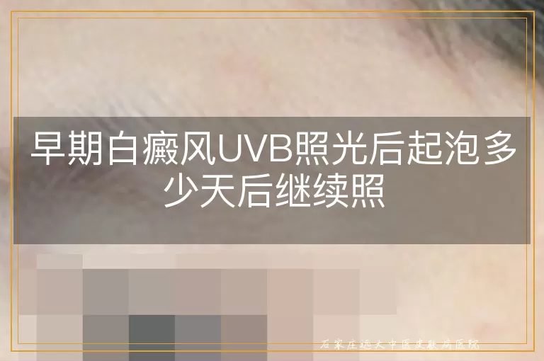 早期白癜风UVB照光后起泡多少天后继续照