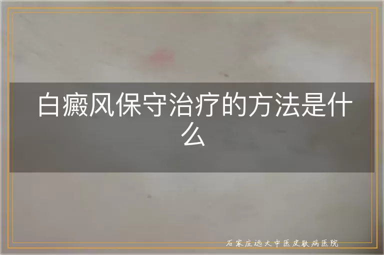 白癜风保守治疗的方法是什么