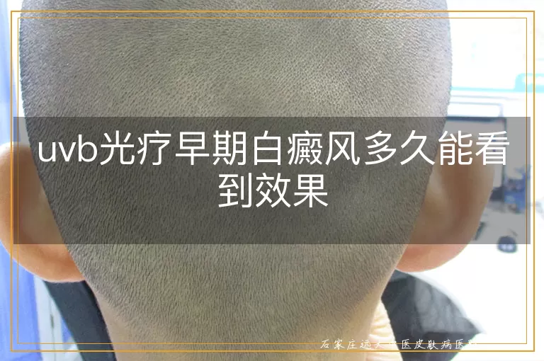 uvb光疗早期白癜风多久能看到效果
