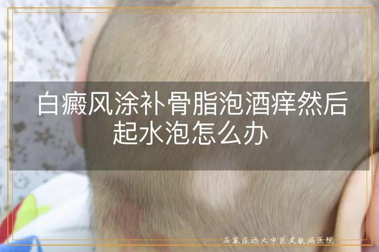 白癜风涂补骨脂泡酒痒然后起水泡怎么办
