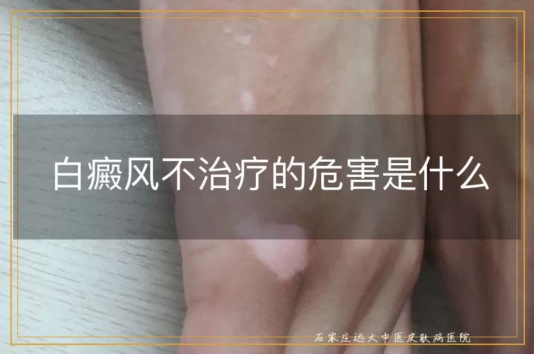 白癜风不治疗的危害是什么