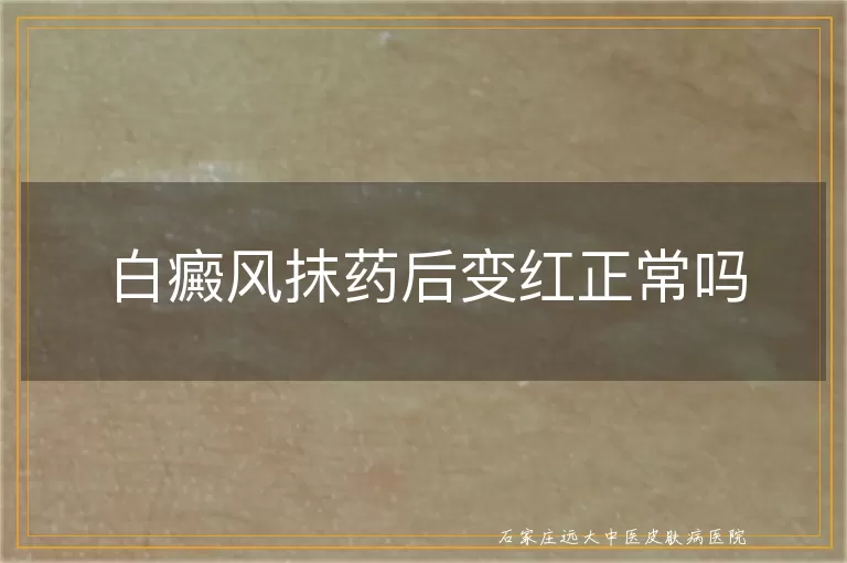 白癜风抹药后变红正常吗