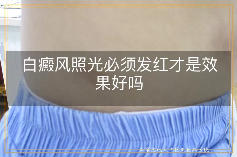 白癜风照光必须发红才是效果好吗