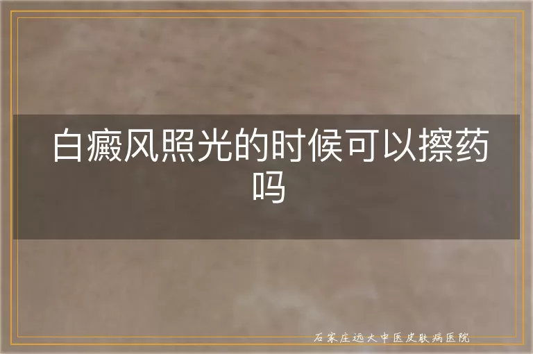 白癜风照光的时候可以擦药吗