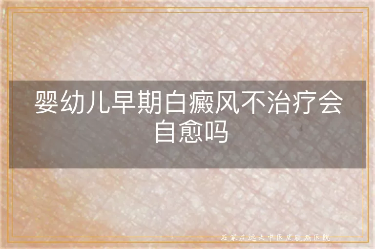 婴幼儿早期白癜风不治疗会自愈吗